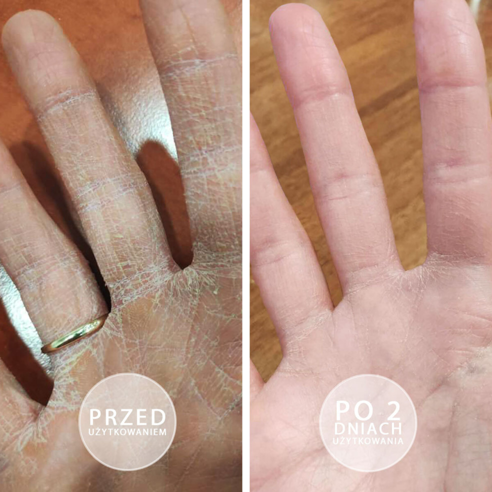 Kobieca dłoń prezentująca efekty przed i po sotosowaniu natłuszczającej maści do rąk