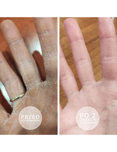 Kobieca dłoń prezentująca efekty przed i po sotosowaniu natłuszczającej maści do rąk